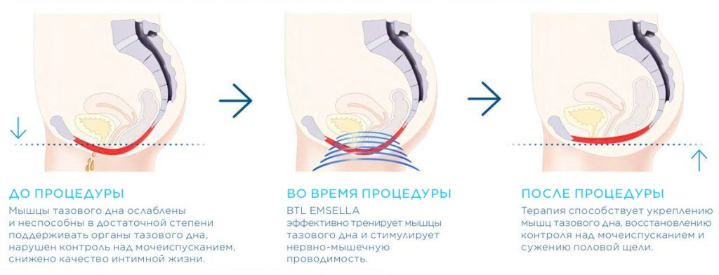 Emsella график